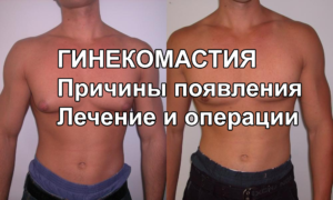 Гинекомастия - причины появления, лечение и операции по удалению, МКБ-10, фото