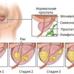 Степени рака простаты