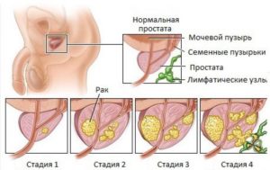 Степени рака простаты